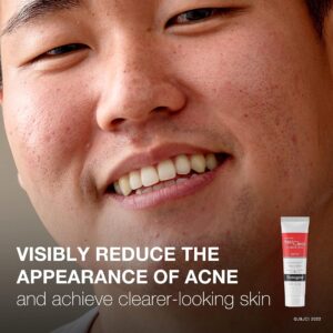 Neutrogena? Rapid Clear Stubborn Acne Spot 10% Benzoyl Peroxide Gel, 1 ounce - Image 6